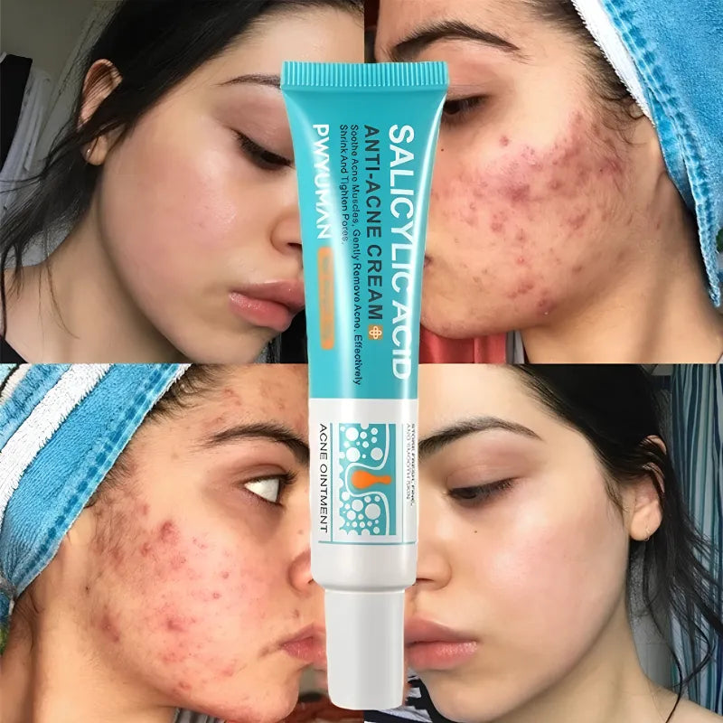 Secativo de Espinhas em Gel - Fórmula Asiática com Ácido Salicílico (Cópia)