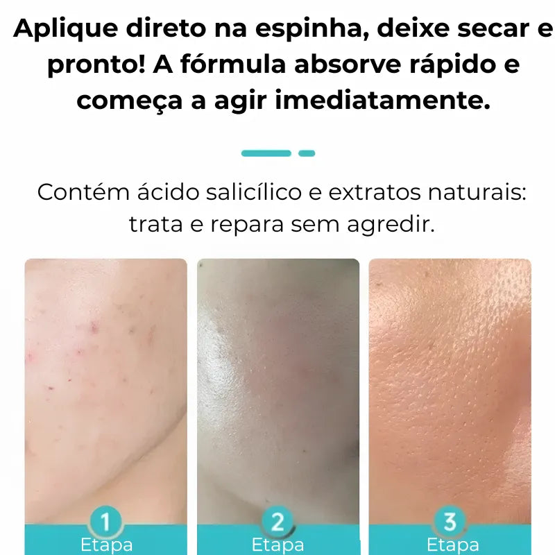 Secativo de Espinhas em Gel - Fórmula Asiática com Ácido Salicílico (Cópia)