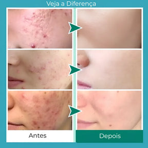 Secativo de Espinhas em Gel - Fórmula Asiática com Ácido Salicílico (Cópia)