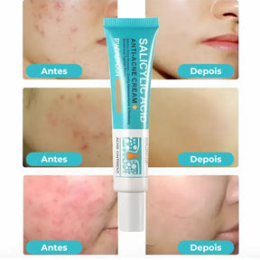 Secativo de Espinhas em Gel - Fórmula Asiática com Ácido Salicílico (Cópia)