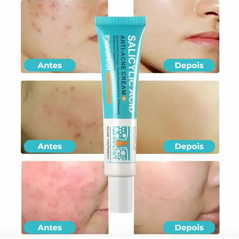 Secativo de Espinhas em Gel - Fórmula Asiática com Ácido Salicílico (Cópia)