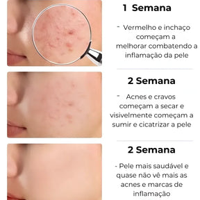 Secativo de Espinhas em Gel - Fórmula Asiática com Ácido Salicílico (Cópia)