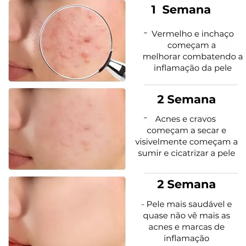 Secativo de Espinhas em Gel - Fórmula Asiática com Ácido Salicílico (Cópia)