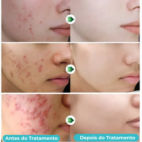 Secativo de Espinhas em Gel - Fórmula Asiática com Ácido Salicílico (Cópia)