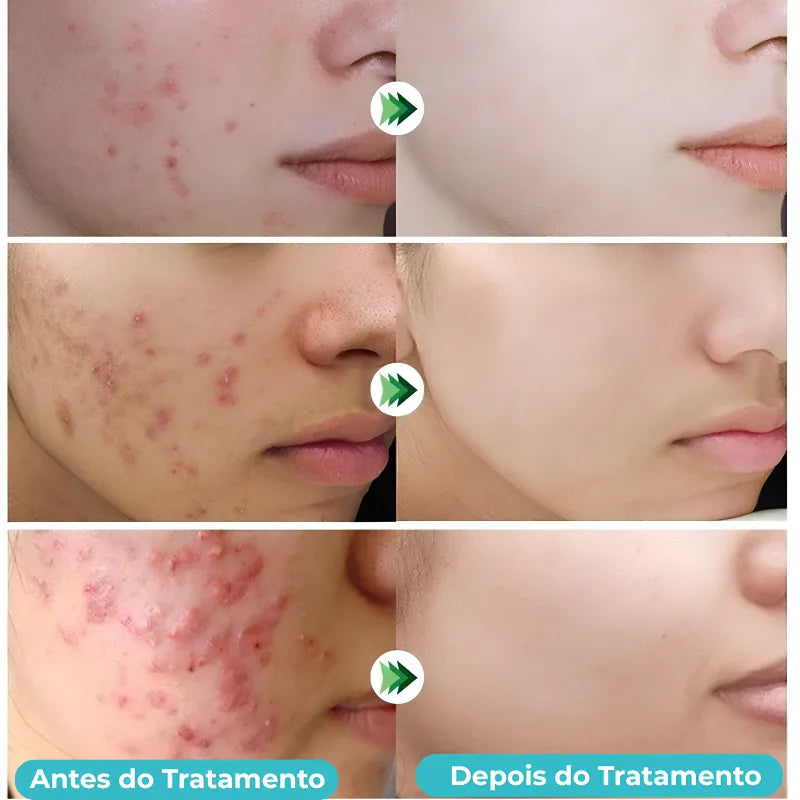 Secativo de Espinhas em Gel - Fórmula Asiática com Ácido Salicílico (Cópia)