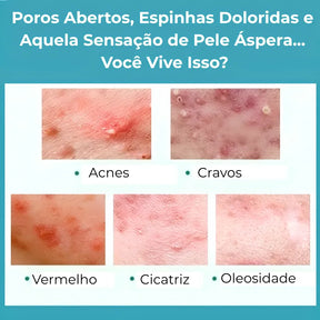 Secativo de Espinhas em Gel - Fórmula Asiática com Ácido Salicílico (Cópia)